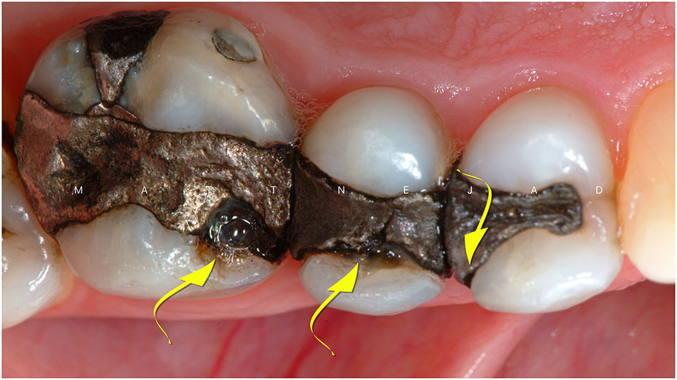  پر کردن دندان با نقره (آمالگام)