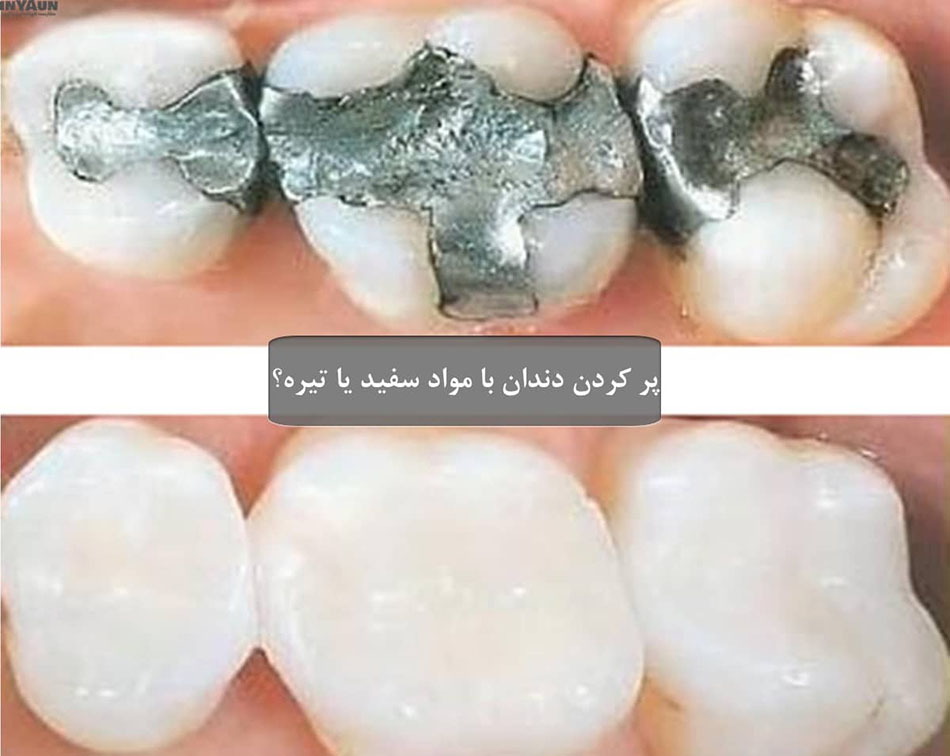 برای پر کردن یک دندان چه اقداماتی لازم است؟