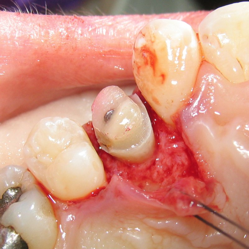 گسترش عفونت دندان