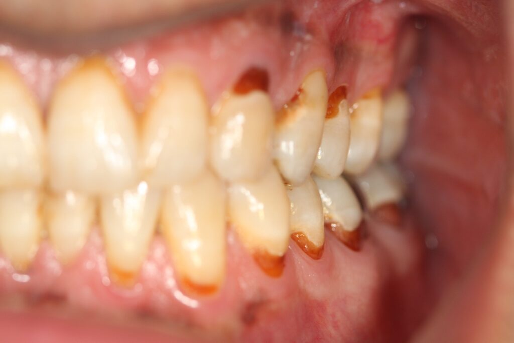 پوسیدگی دندان چ