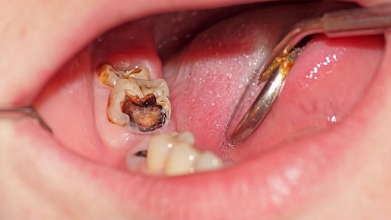 پوسیدگی دندان 