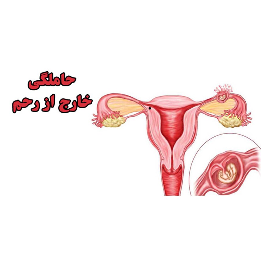 بارداری خارج ازرحم