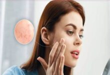 بهترین قرص برای جوش صورت