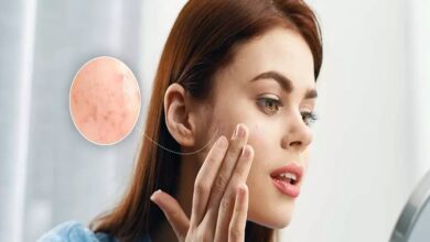 بهترین قرص برای جوش صورت
