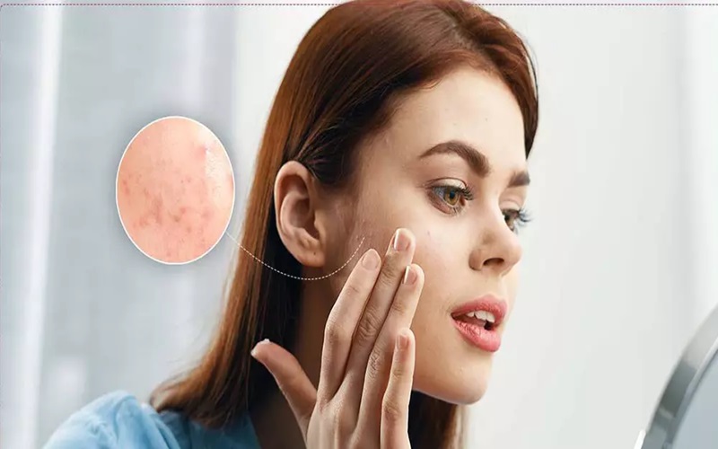 بهترین قرص برای جوش صورت