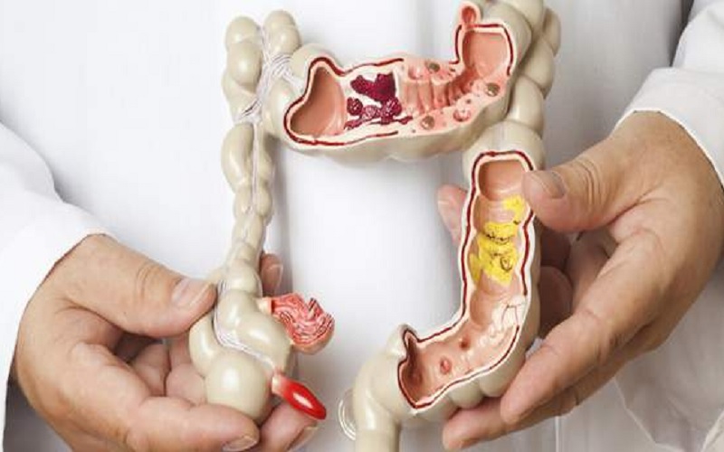 درمان بواسیر