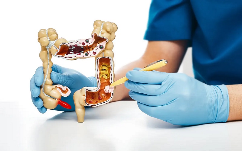 درمان شکاف مقعدی