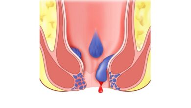 ۱۵ علت خونریزی مقعد + روش درمان آنها