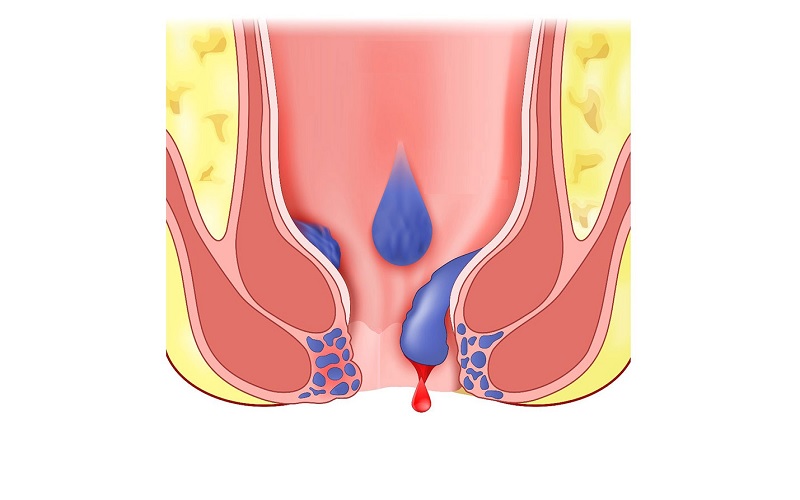 ۱۵ علت خونریزی مقعد + روش درمان آنها