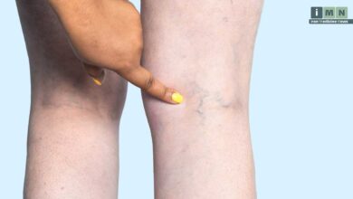 واریس چیست: علائم، علل، درمان و پیشگیری از رگ های برجسته پا