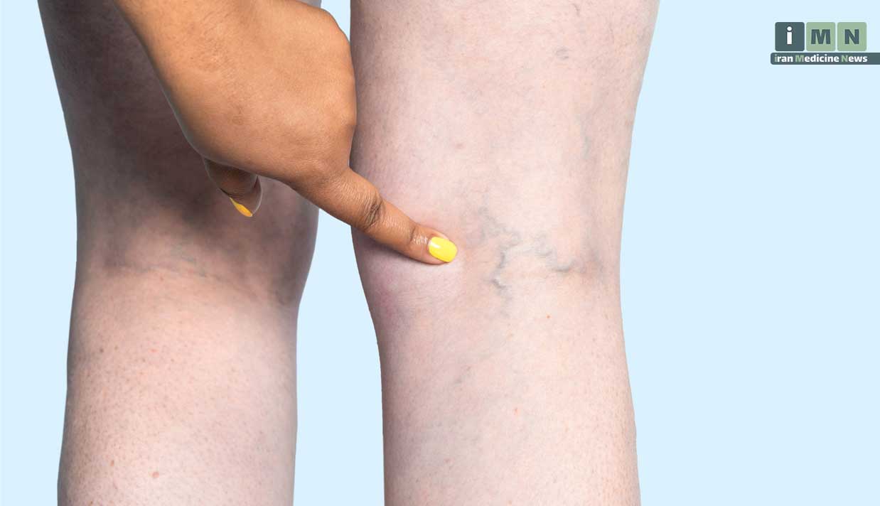 واریس چیست: علائم، علل، درمان و پیشگیری از رگ های برجسته پا