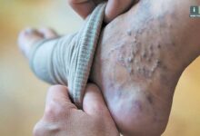 روش های پیشگیری و درمان خانگی واریس