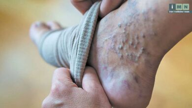 روش های پیشگیری و درمان خانگی واریس