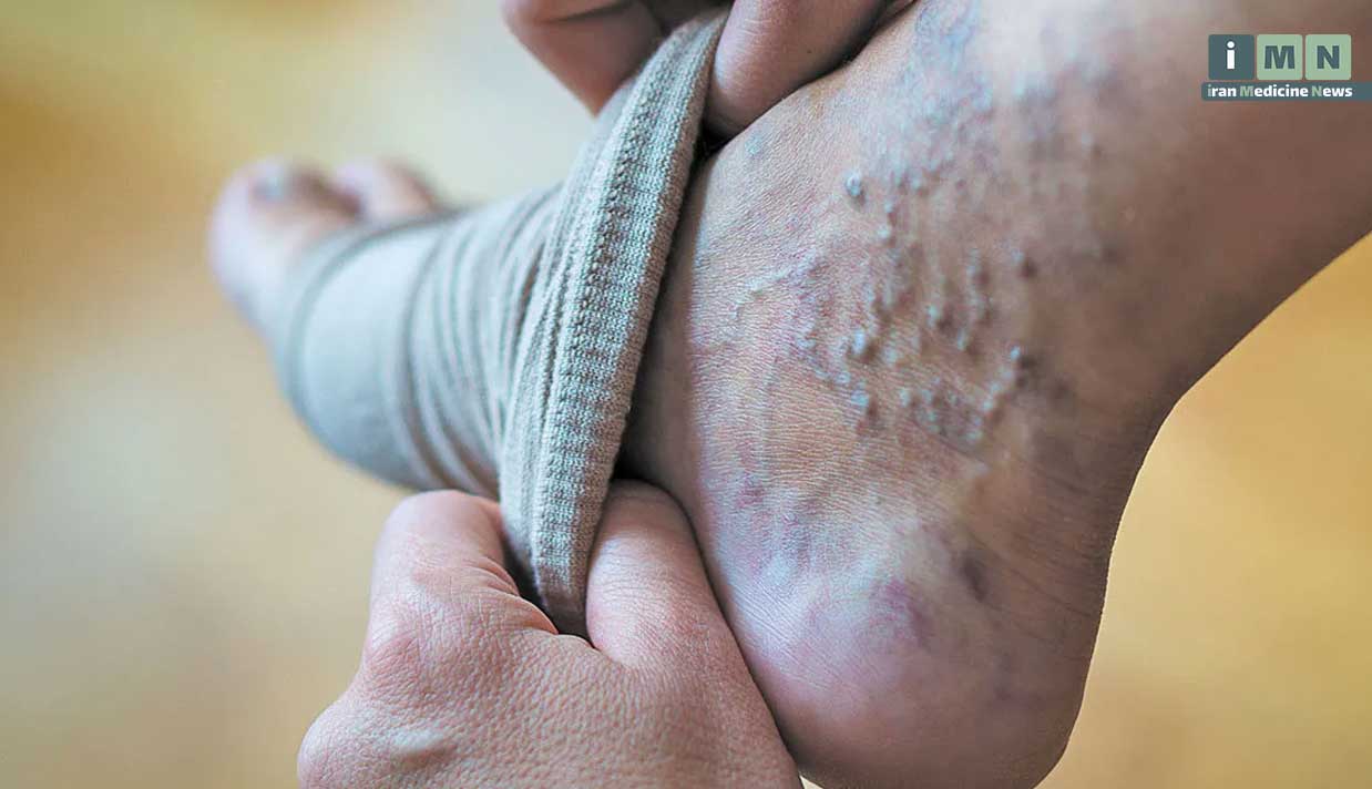 روش های پیشگیری و درمان خانگی واریس