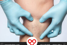 تاثیر گرما و سرما بر واریس