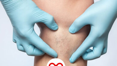 تاثیر گرما و سرما بر واریس