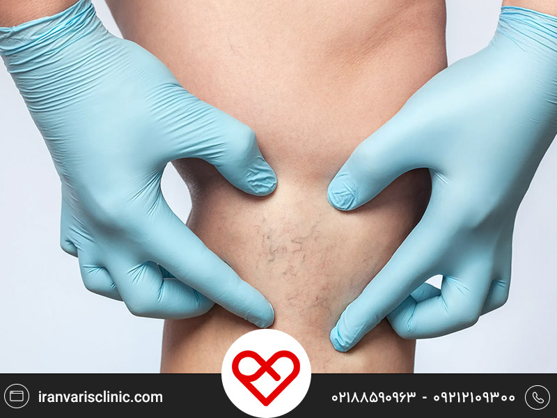 تاثیر گرما و سرما بر واریس