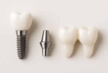 مقایسه ایمپنت اوردنچر و بریج دندان