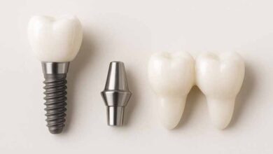 مقایسه ایمپنت اوردنچر و بریج دندان