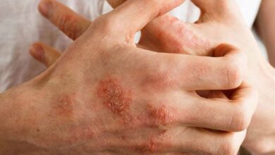 ایا بیماری پوستی صدف خطرناک است