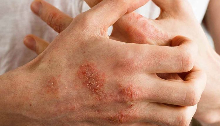 ایا بیماری پوستی صدف خطرناک است