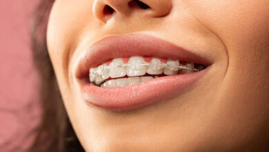 ارتودنسی سرامیکی