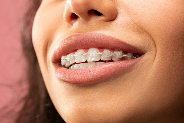 ارتودنسی سرامیکی