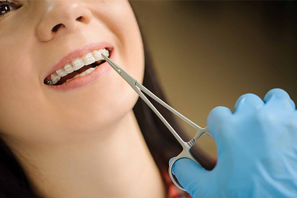 ارتودنسی سرامیکی